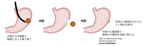 胃 黏膜 下 腫瘤